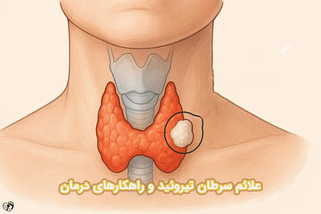 سرطان تیروئید سرطان تیروئید