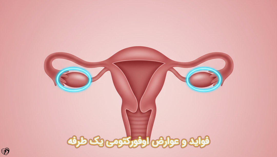 اوفورکتومی یک طرفه اوفورکتومی یک طرفه