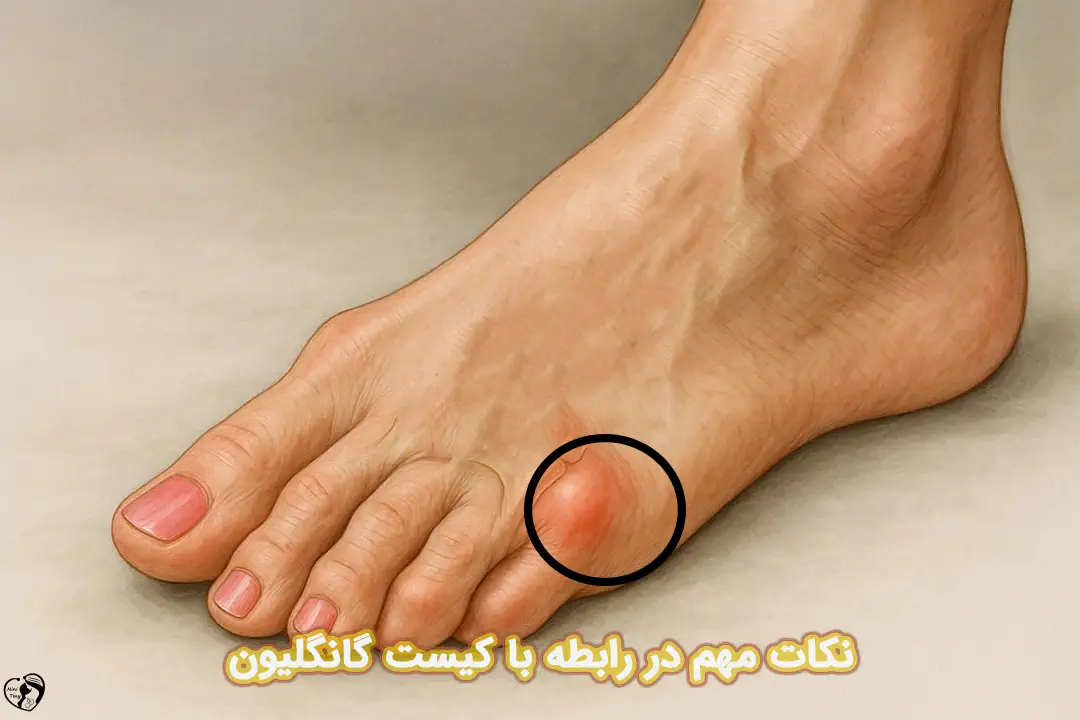 کیست گانگلیون