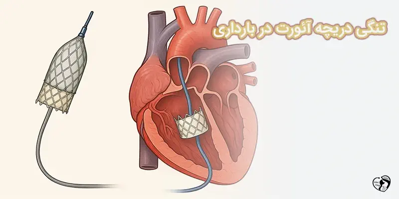 tangi aort تنگی دریچه آئورت در بارداری