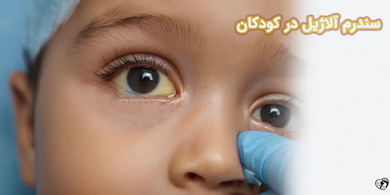 Alagille Syndrome سندرم آلاژیل در کودکان