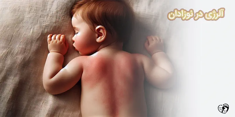 Allergies in Babies1 آلرژی در نوزادان