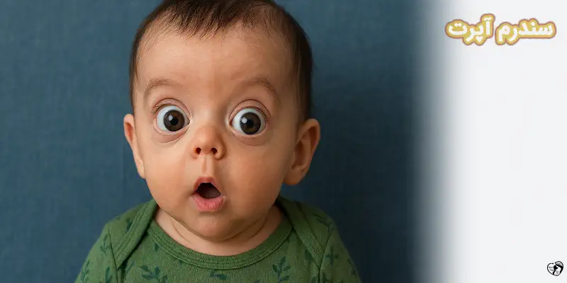 Apert Syndrome Apert Syndrome