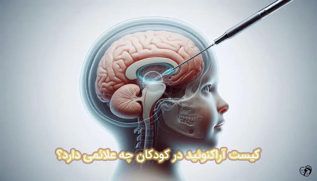 کیست آراکنوئید کیست آراکنوئید