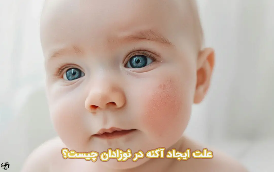 آکنه نوزادی
