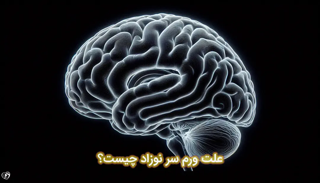 ورم سر نوزاد کاپوت سوکسدانیوم