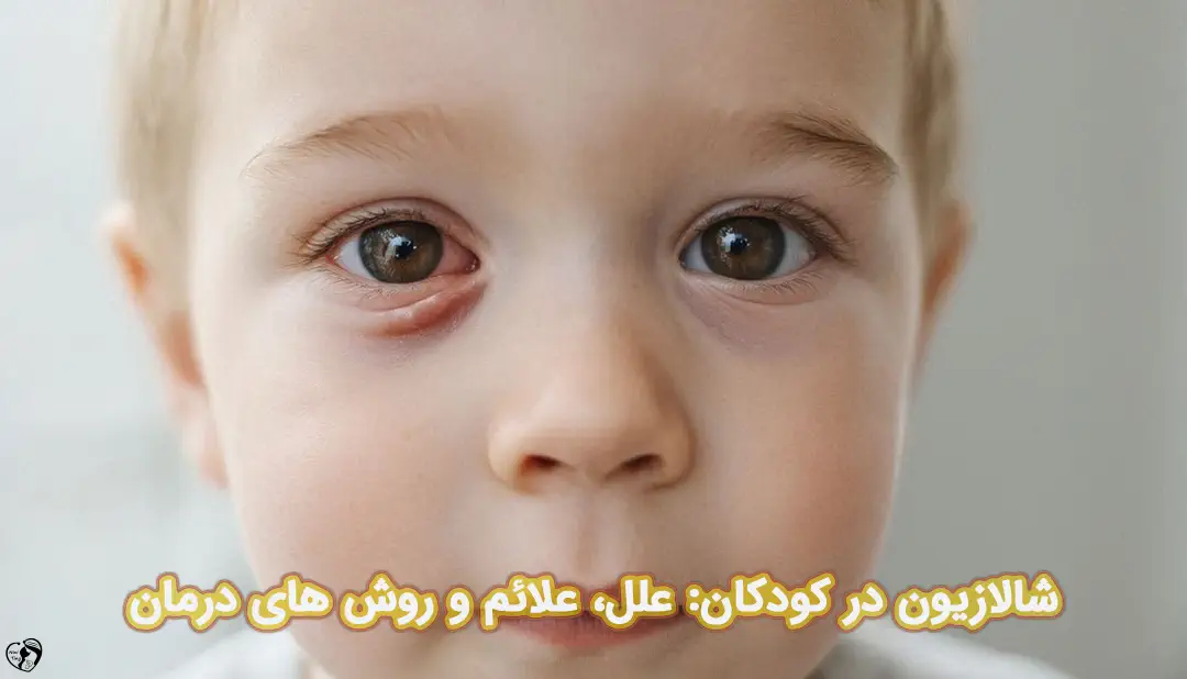 شالازیون در کودکان