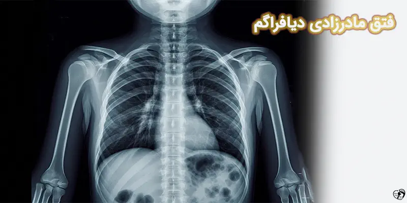 Congenital Diaphragmatic Hernia فتق مادرزادی دیافراگم