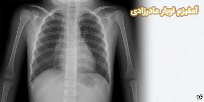 Congenital Lobar Emphysema CLE آمفیزم لوبار مادرزادی