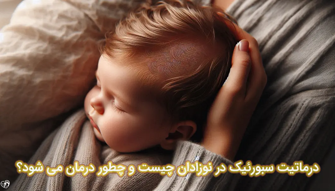 درماتیت سبورئیک در نوزادان