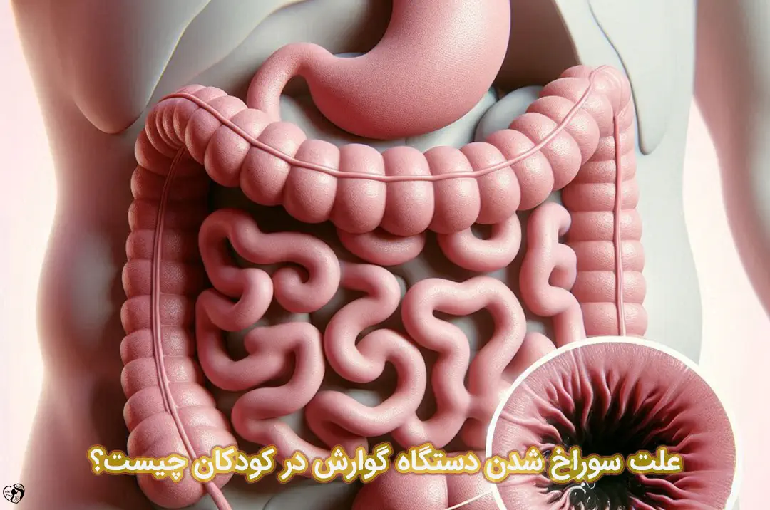 سوراخ شدن دستگاه گوارش در کودکان