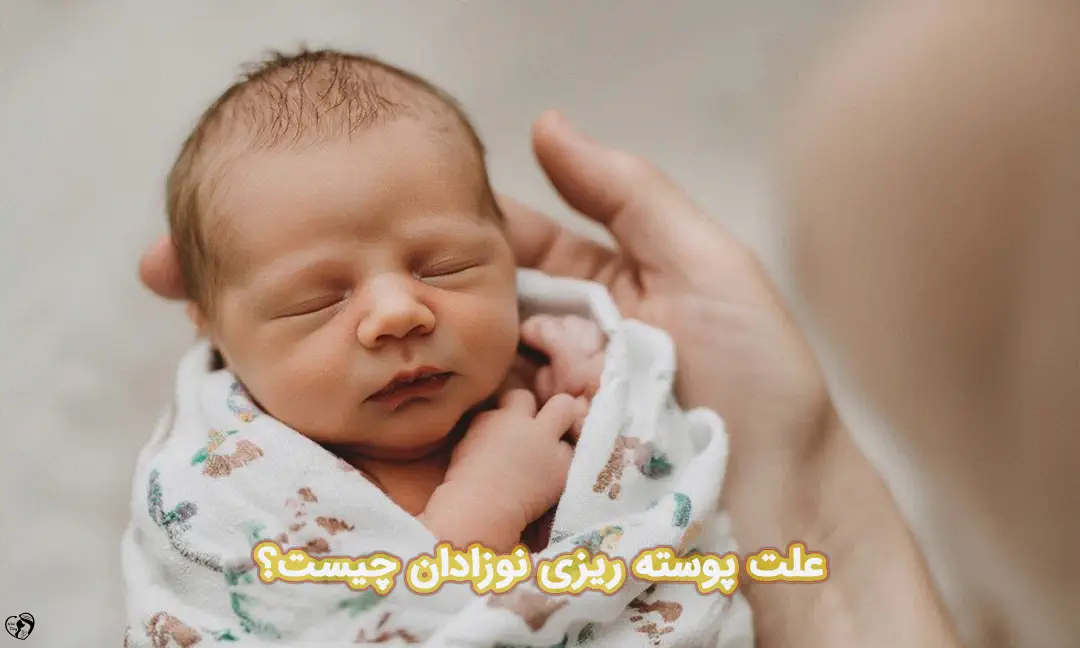 پوسته ریزی نوزاد