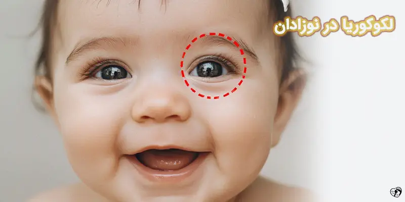 Leukocoria لکوکوریا در نوزادان