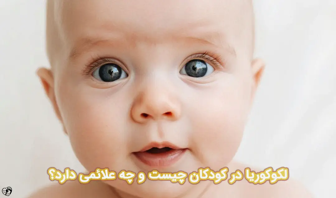 لکوکوریا در نوزادان لکوکوریا در نوزادان