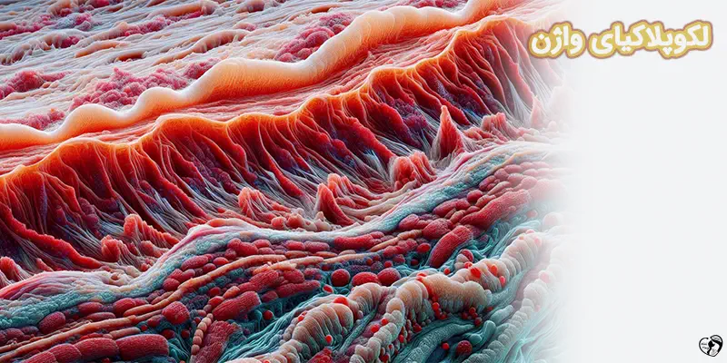 Leukoplakia of the vulva لکوپلاکیای واژن