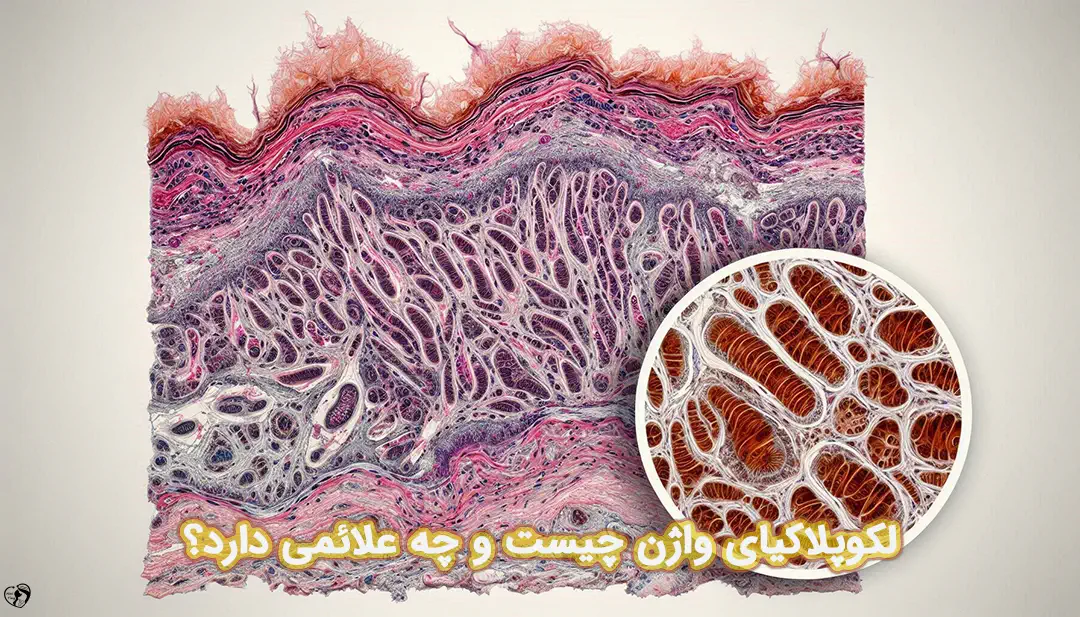 لکوپلاکیای واژن