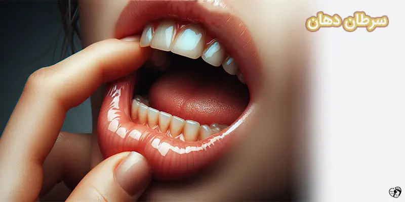 Oral Cancer سزطان دهان