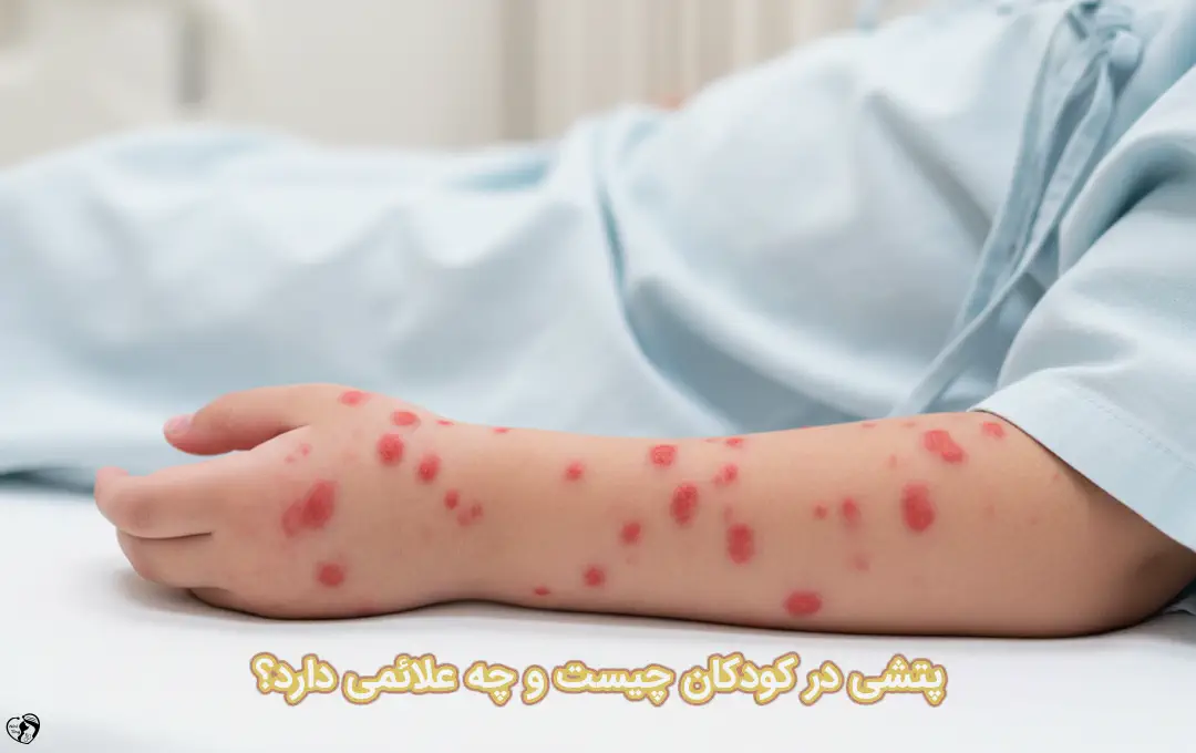 پتشی در کودکان