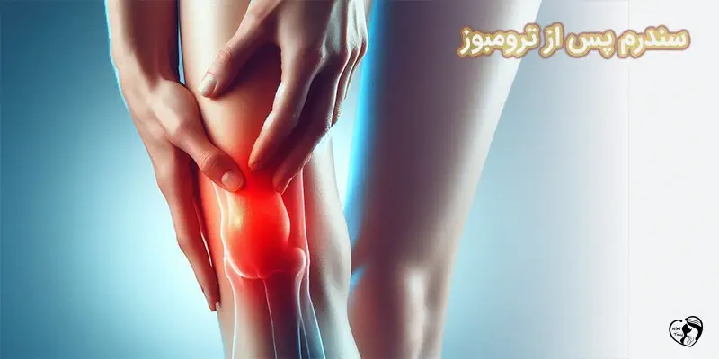سندرم پس از ترومبوز سندرم پس از ترومبوز