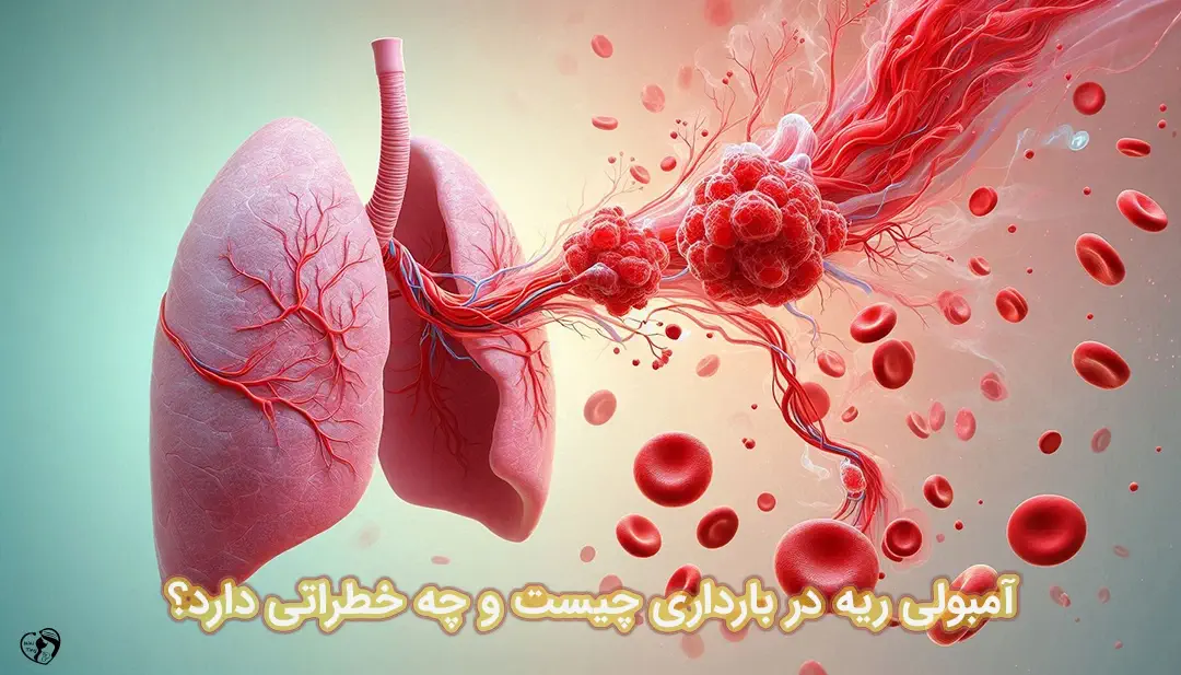 آمبولی ریه در بارداری آمبولی ریه در بارداری