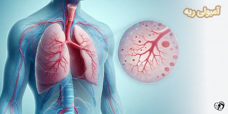 Pulmonary Embolism آمبولی ریه