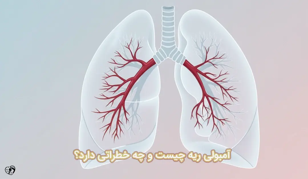 آمبولی ریه آمبولی ریه