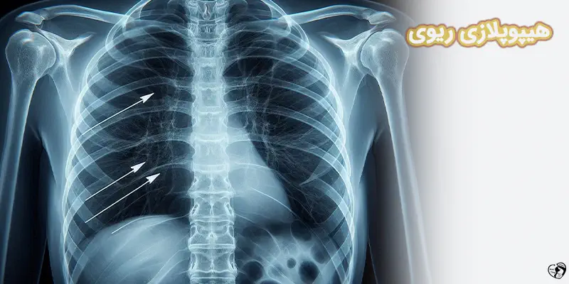Pulmonary Hypoplasia هیپوپلازی ریوی