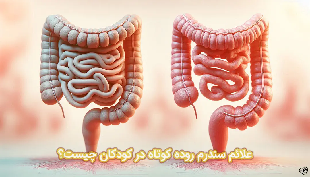 سندرم روده کوتاه در کودکان