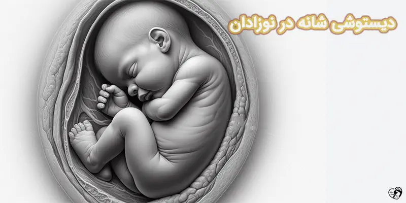 Shoulder Dystocia دیستوشی شانه در نوزادان