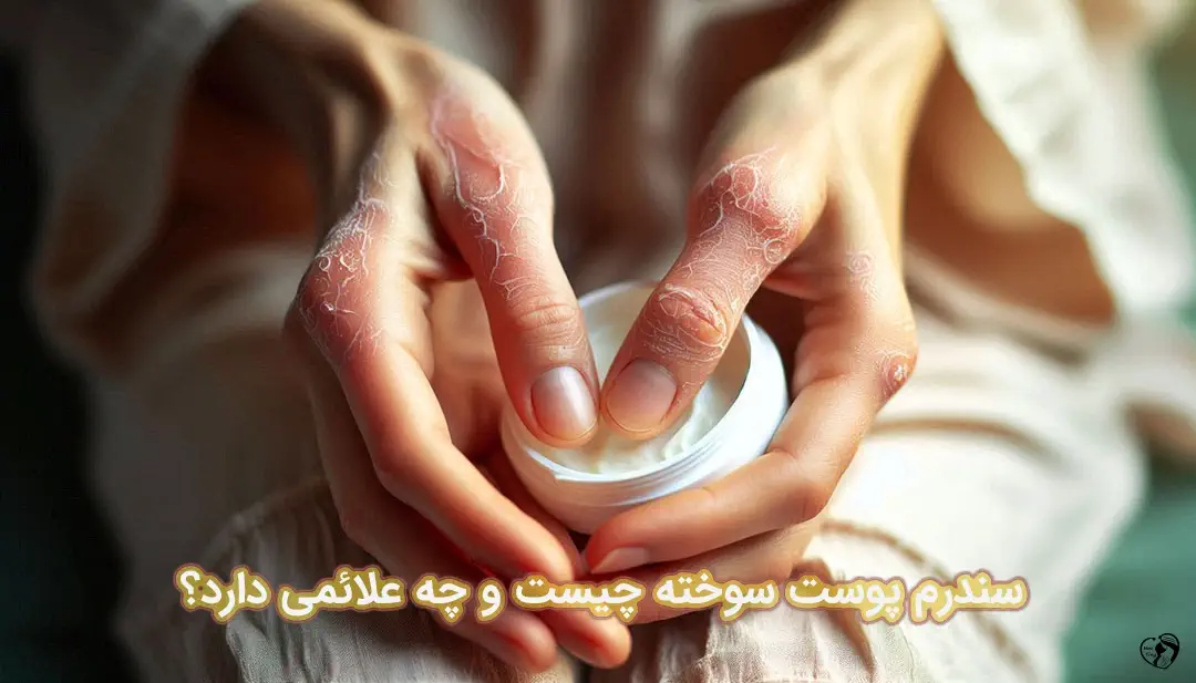 سندرم پوست سوخته سندرم پوست سوخته