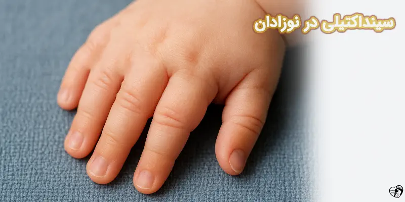 Syndactyly Webbed Toes or Fingers سینداکتیلی در نوزادان