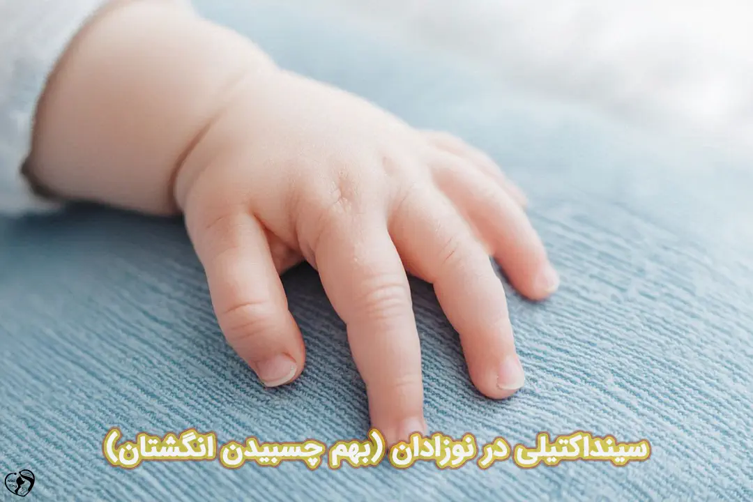 سینداکتیلی در نوزادان سینداکتیلی در نوزادان