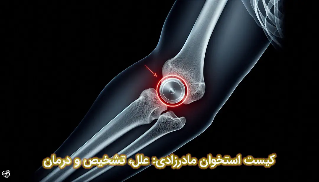 کیست استخوان مادرزادی