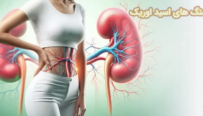 سنگ های اسید اوریک