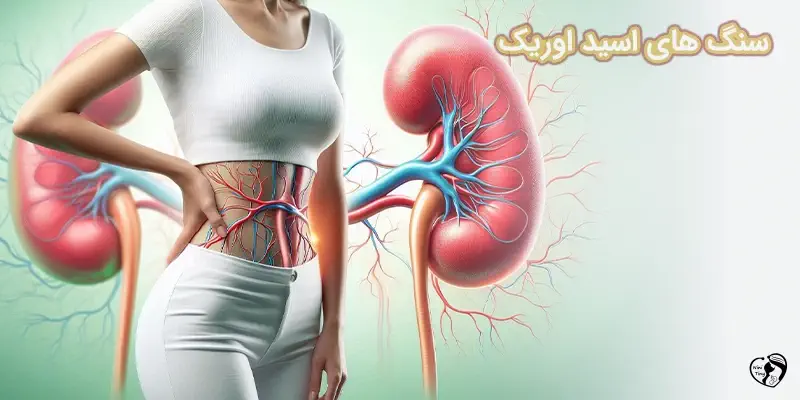 سنگ های اسید اوریک سنگ های اسید اوریک کلیه