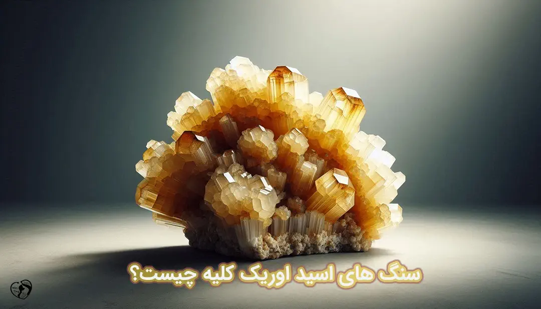 سنگ های اسید اوریک سنگ های اسید اوریک