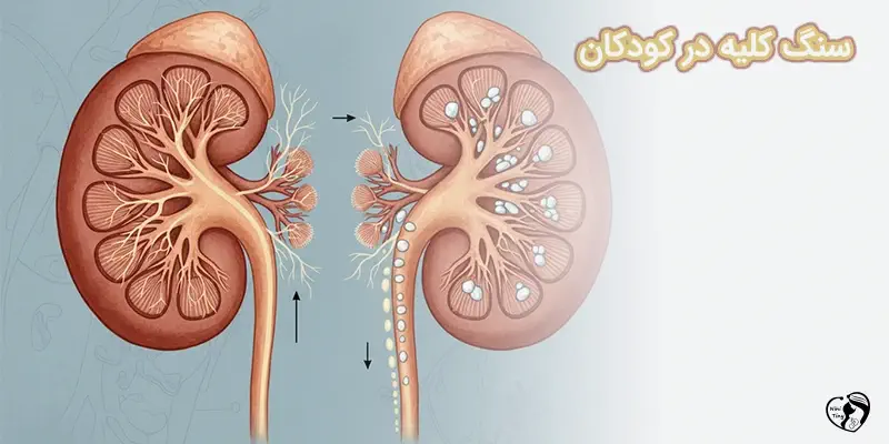 sang kolie dar kodakan1 سنگ کلیه در کودکان