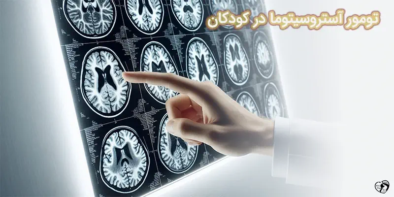 تومور آستروسیتوما در کودکان