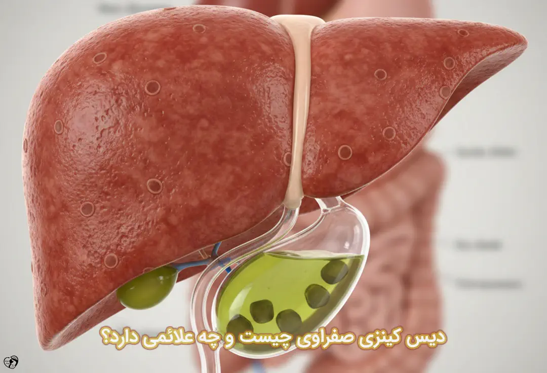 دیس کینزی صفراوی در کودکان