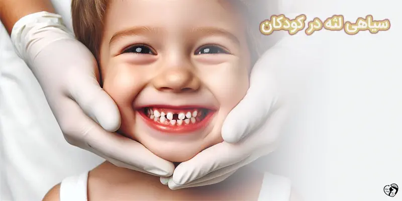 Black Gums in Kids سیاهی لثه در کودکان