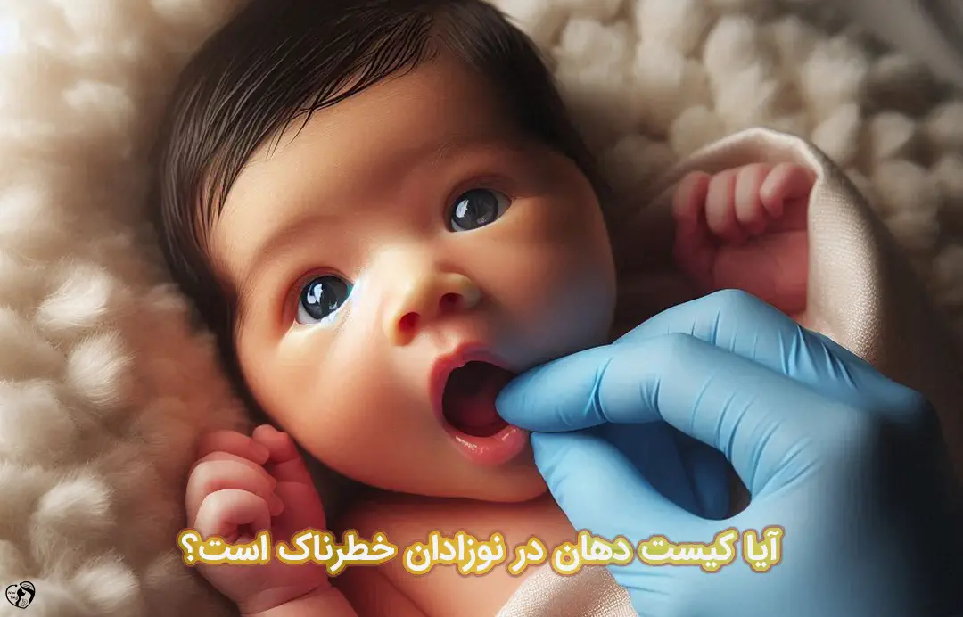 کیست دهان در نوزادان