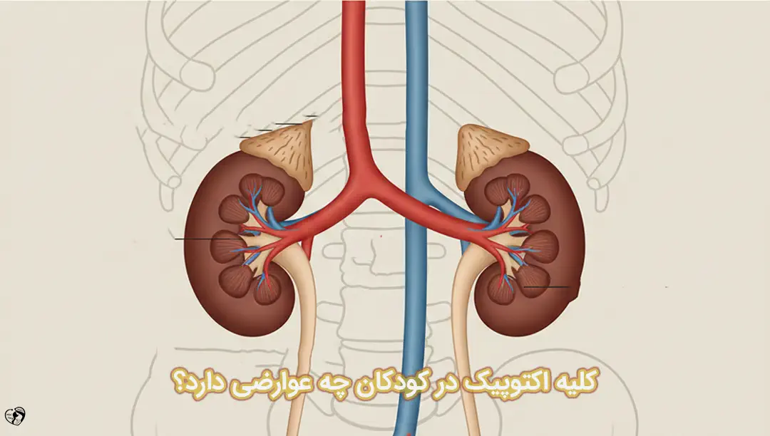 کلیه اکتوپیک در کودکان کلیه اکتوپیک در کودکان