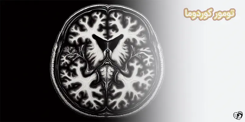 تومور کوردوما