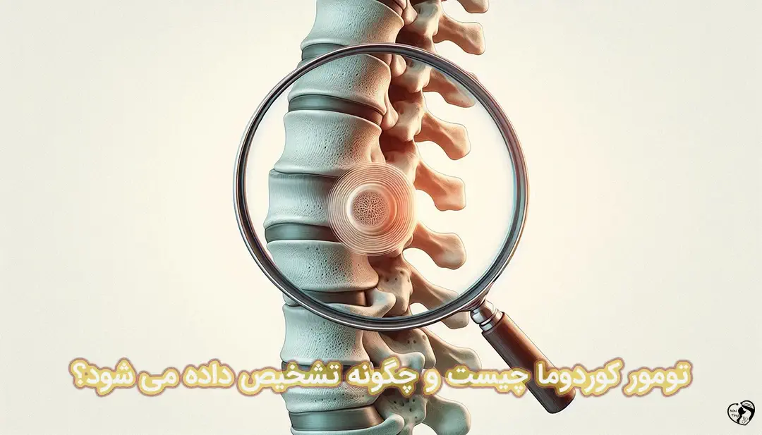 تومور کوردوما تومور کوردوما