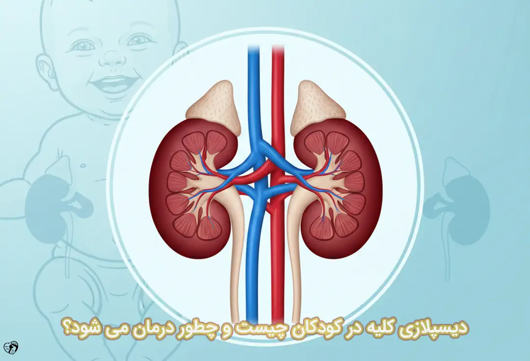 دیسپلازی کلیه در کودکان دیسپلازی کلیه در کودکان
