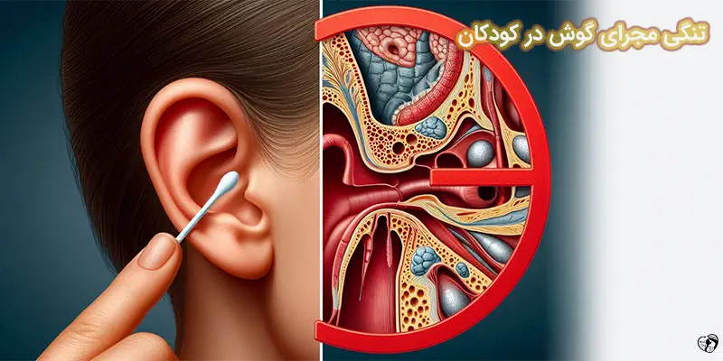 Ear Canal Stenosis تنگی مجرای گوش در کودکان