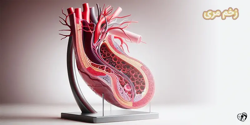 Esophageal ulcer زحم مری