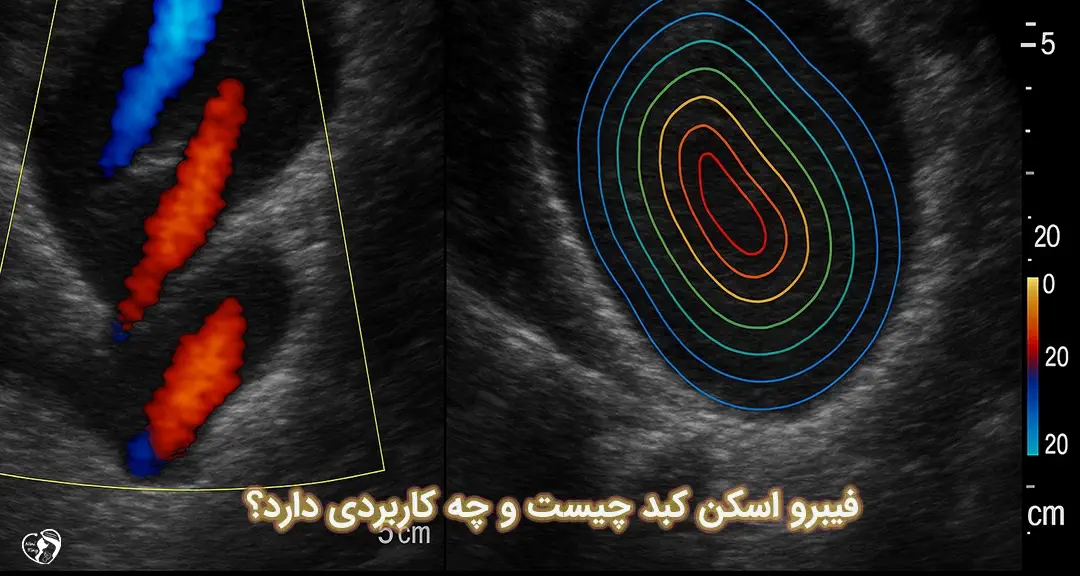 فیبرو اسکن کبد فیبرو اسکن کبد