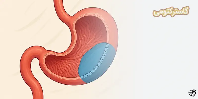 Gastrectomy گاسترکتومی