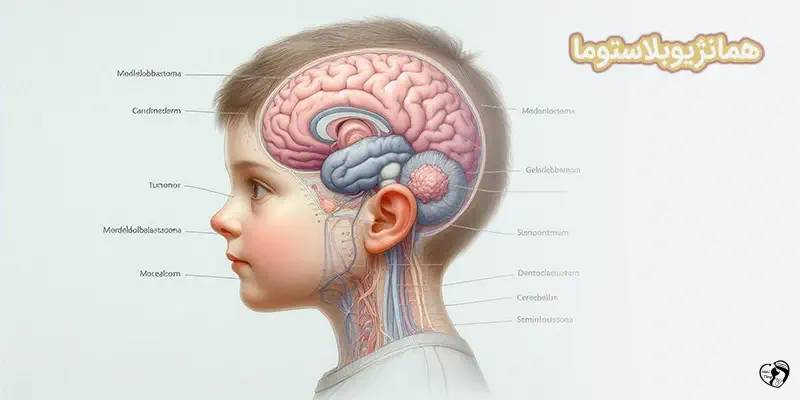همانژیوبلاستوم